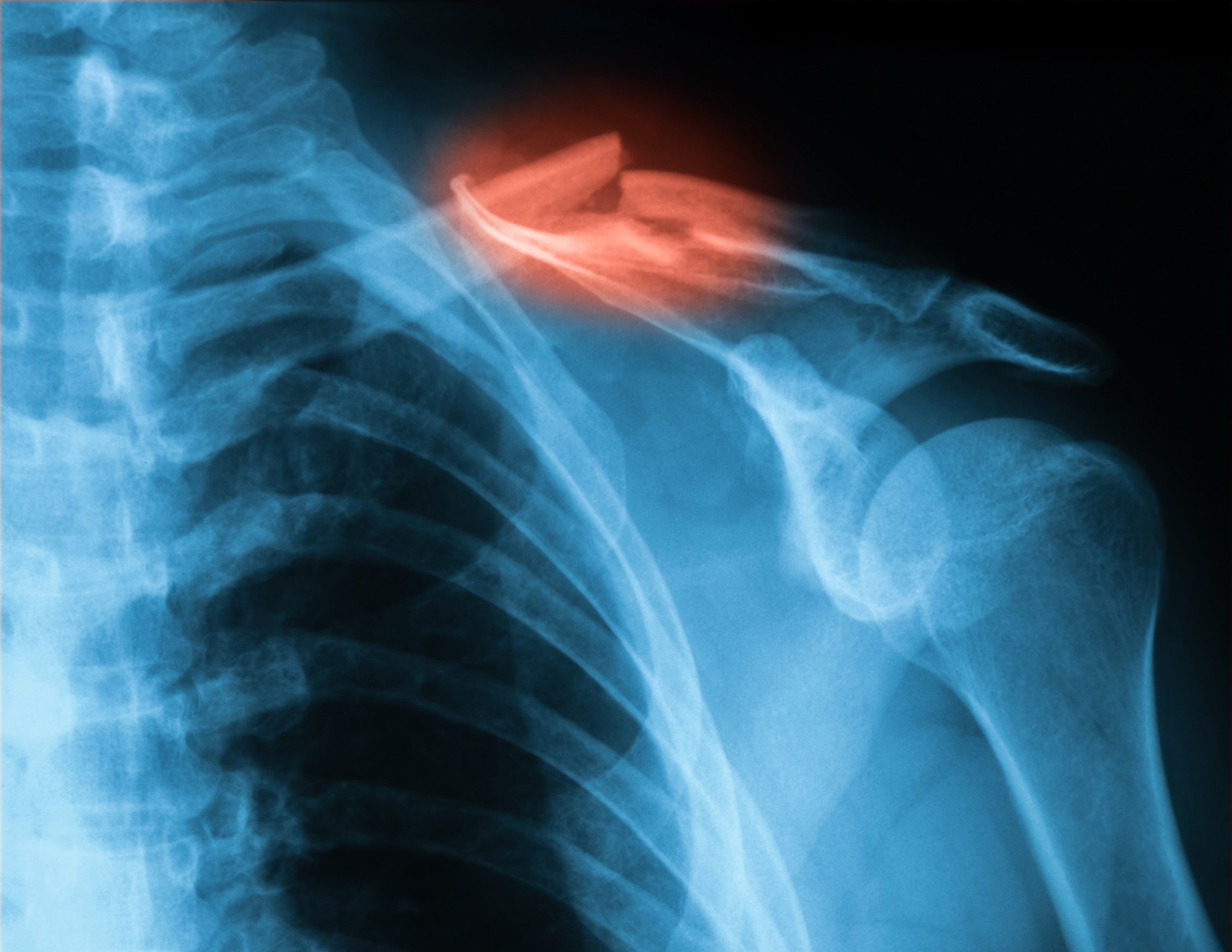 X-ray image of clavicle, AP view., showing clavicle fracture